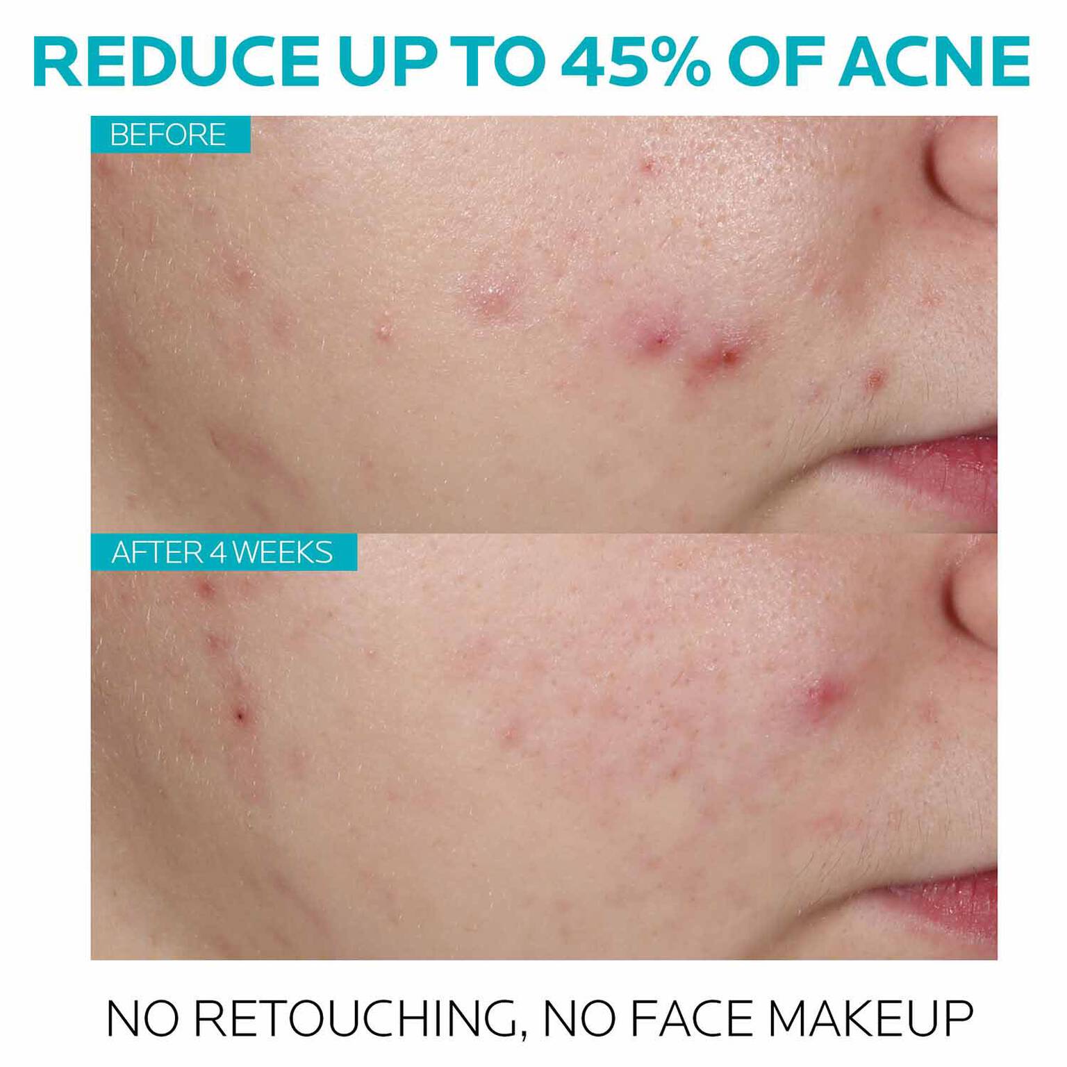 effaclar-salicylic-acid-acne-treatment-serum-g5 7_EffaclarSerum_After-45-days.jpg
