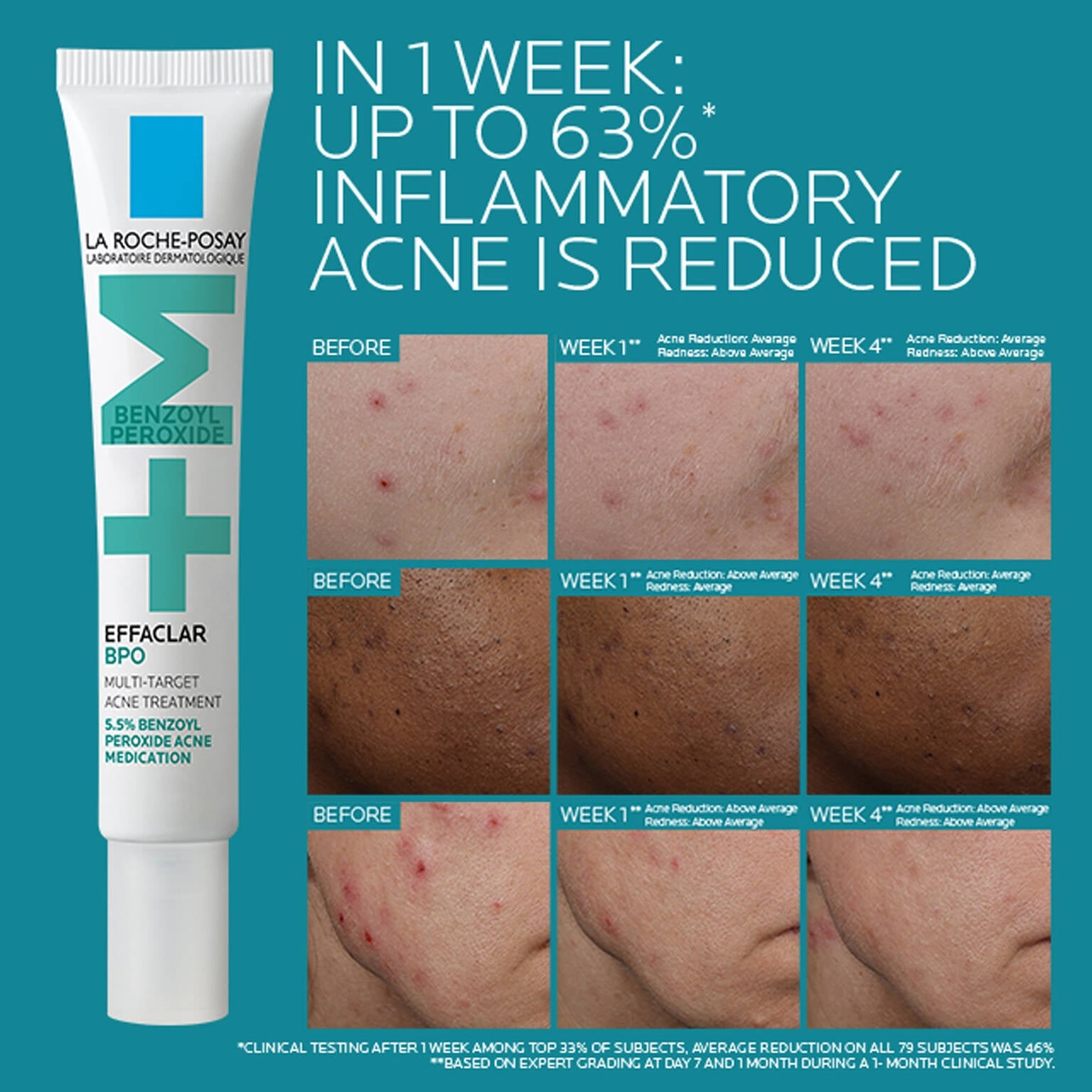 effaclar-bpo-multi-target-acne-treatment-with-5-5-benzoyl-peroxide-o1 EffaclarBPO-ClinicalBA-ATF-1500x1500-2.jpg