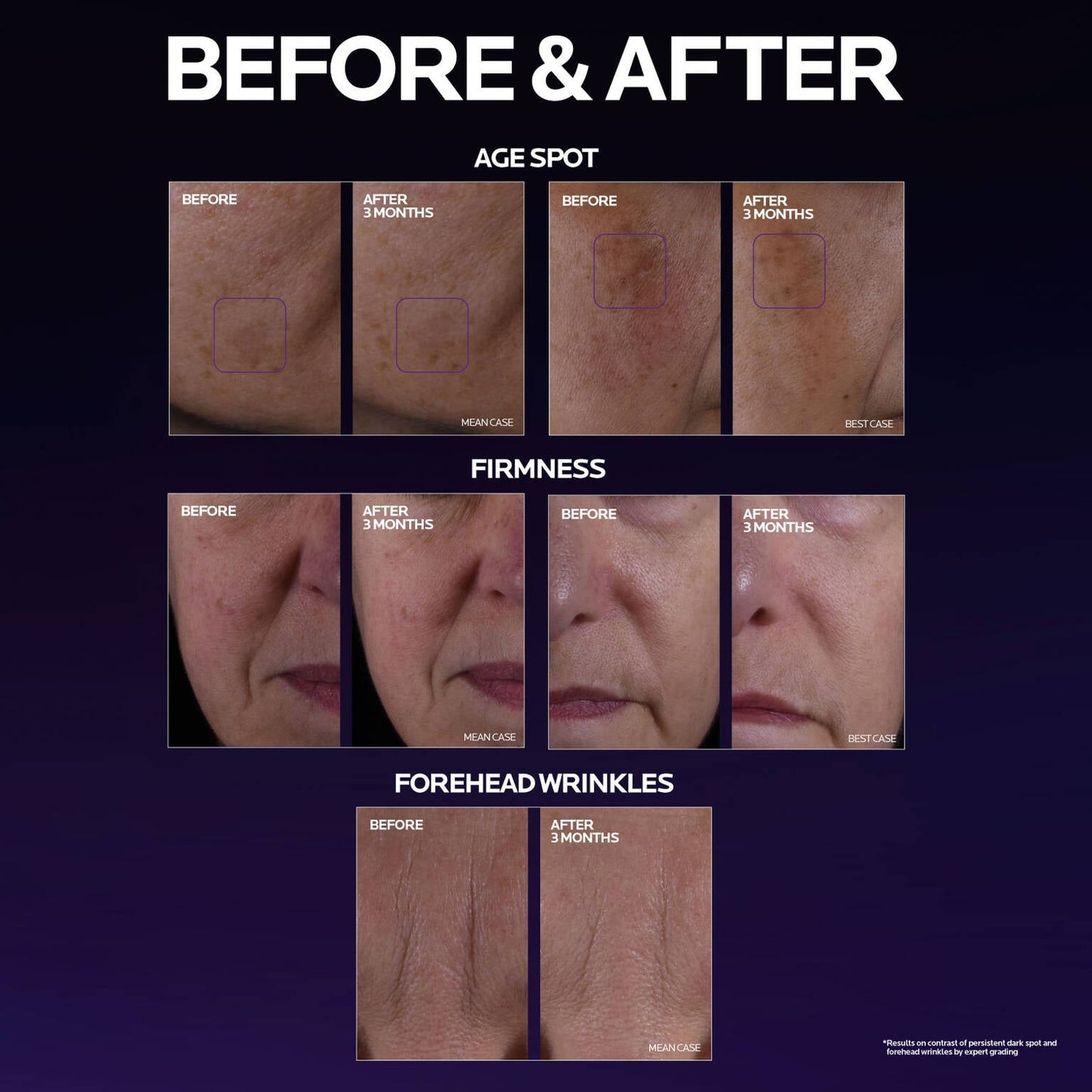 mela-b3-double-dose-discoloration-treatment-with-melasyltm-p6 MelaB3_DD_BTF_BeforeAfter_1500x1500_5.jpg