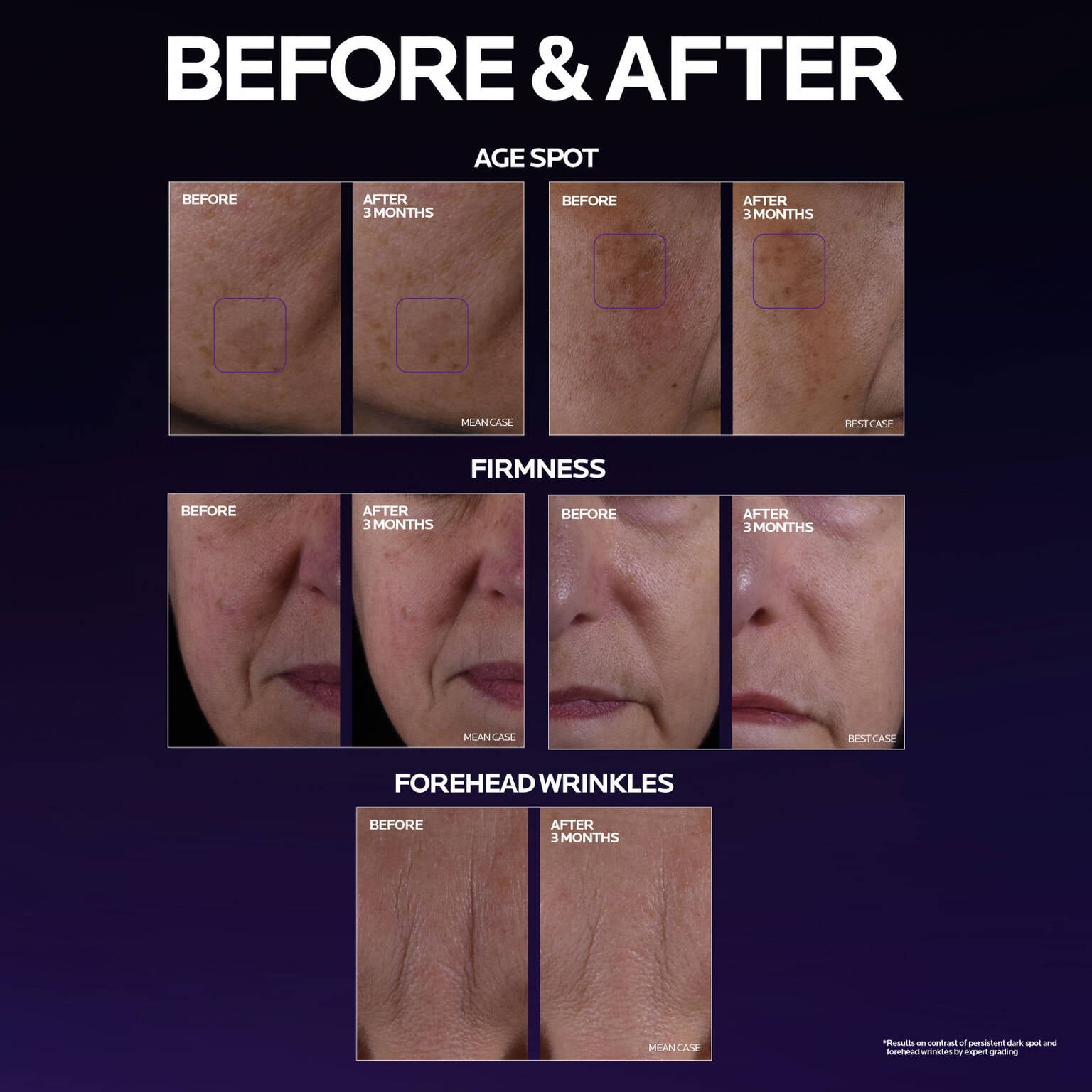 mela-b3-double-dose-discoloration-treatment-with-melasyltm-p6 MelaB3_DD_BTF_BeforeAfter_1500x1500_5.jpg